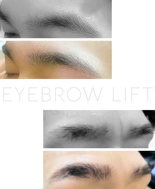 EYEBROW LIFT